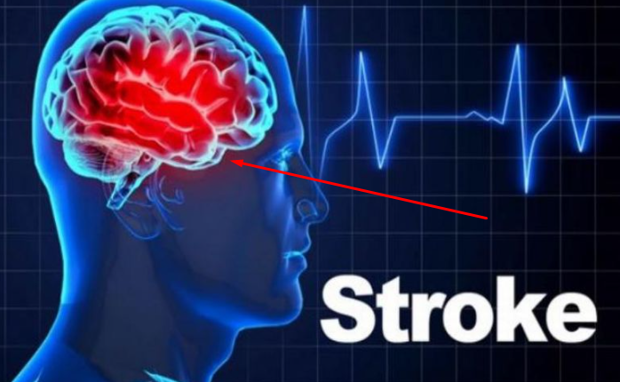 Anda Mengidap Stroke, Apa Penyebabnya dan Bagaimana Cara Mengatasinya?